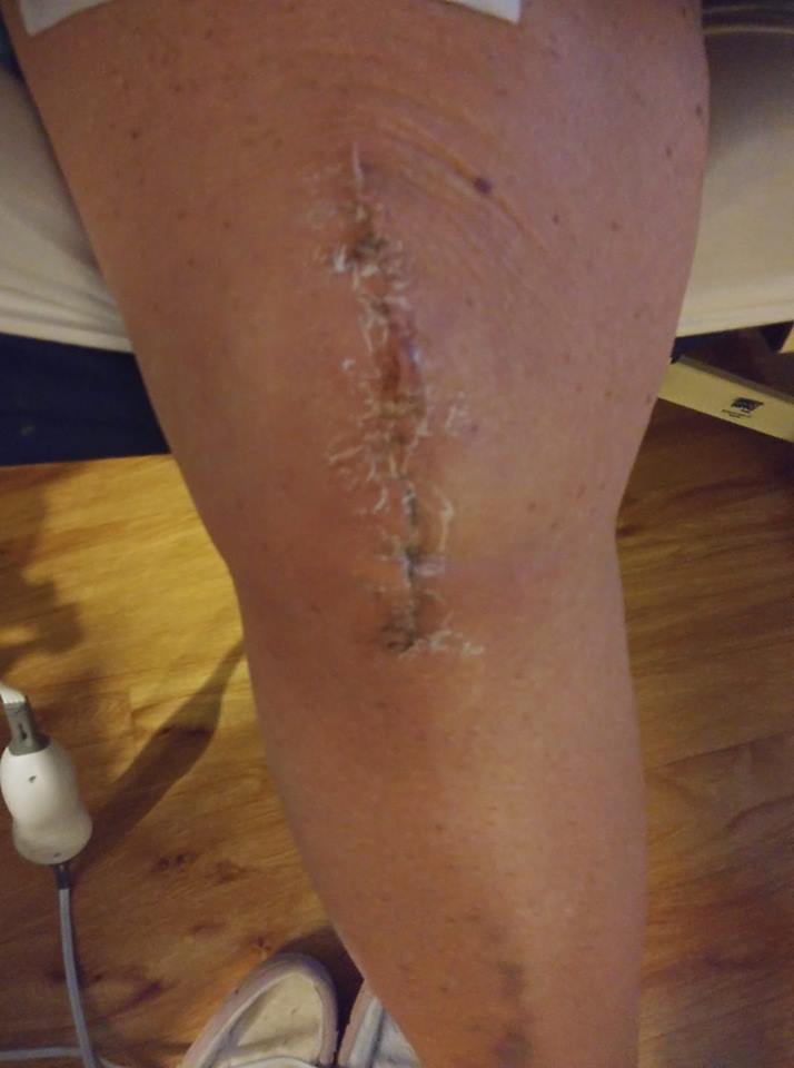 knee-replacement-scar-recovery-timeline-a-photo-gallery